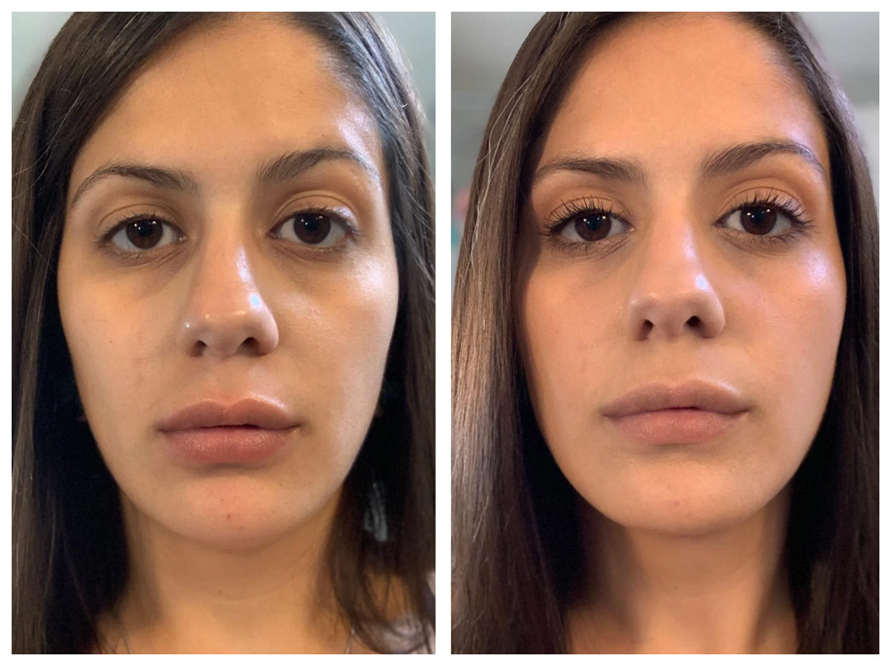 Dark Circles Treatment in Mumbai - Cost, Before After, Laser Treatment