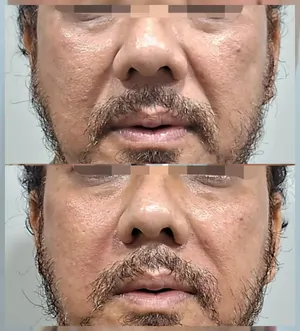 lip-filler