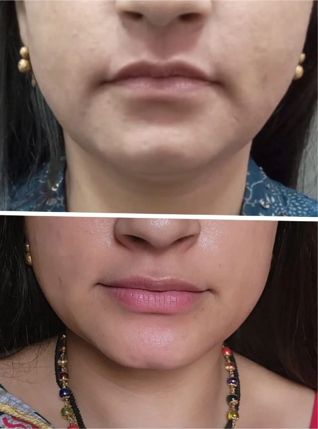 lip-filler