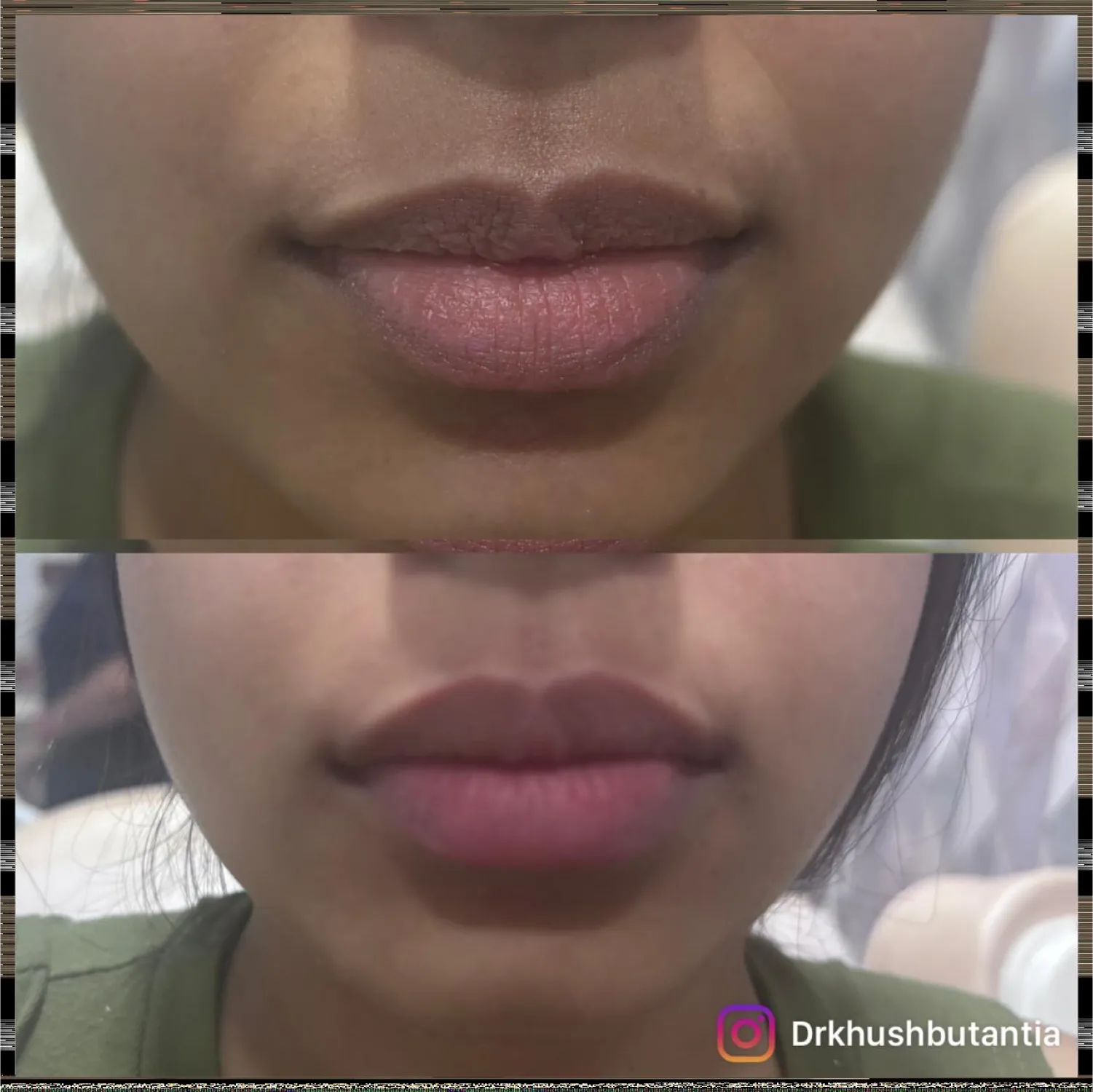 lip-filler