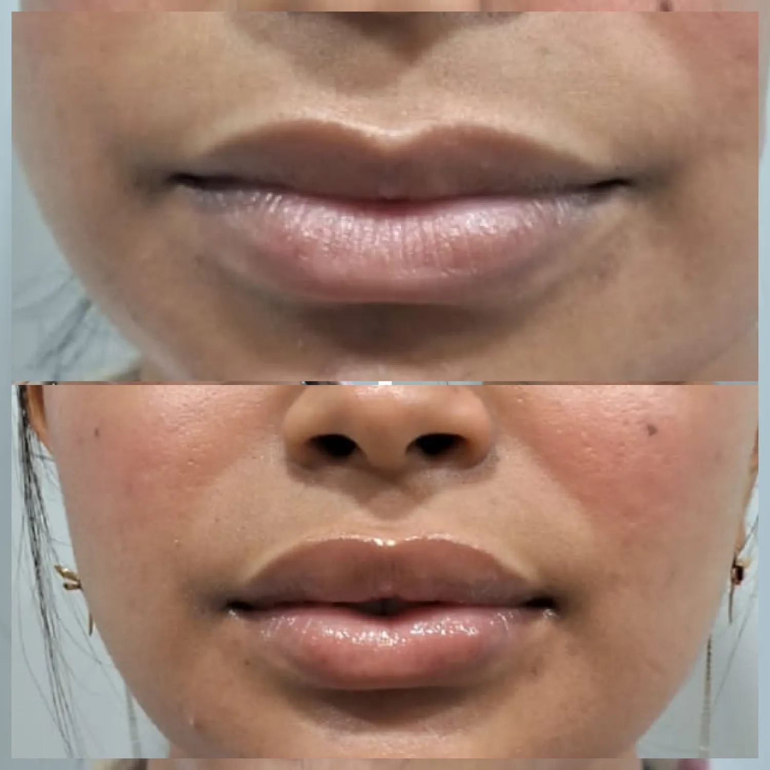 lip-filler