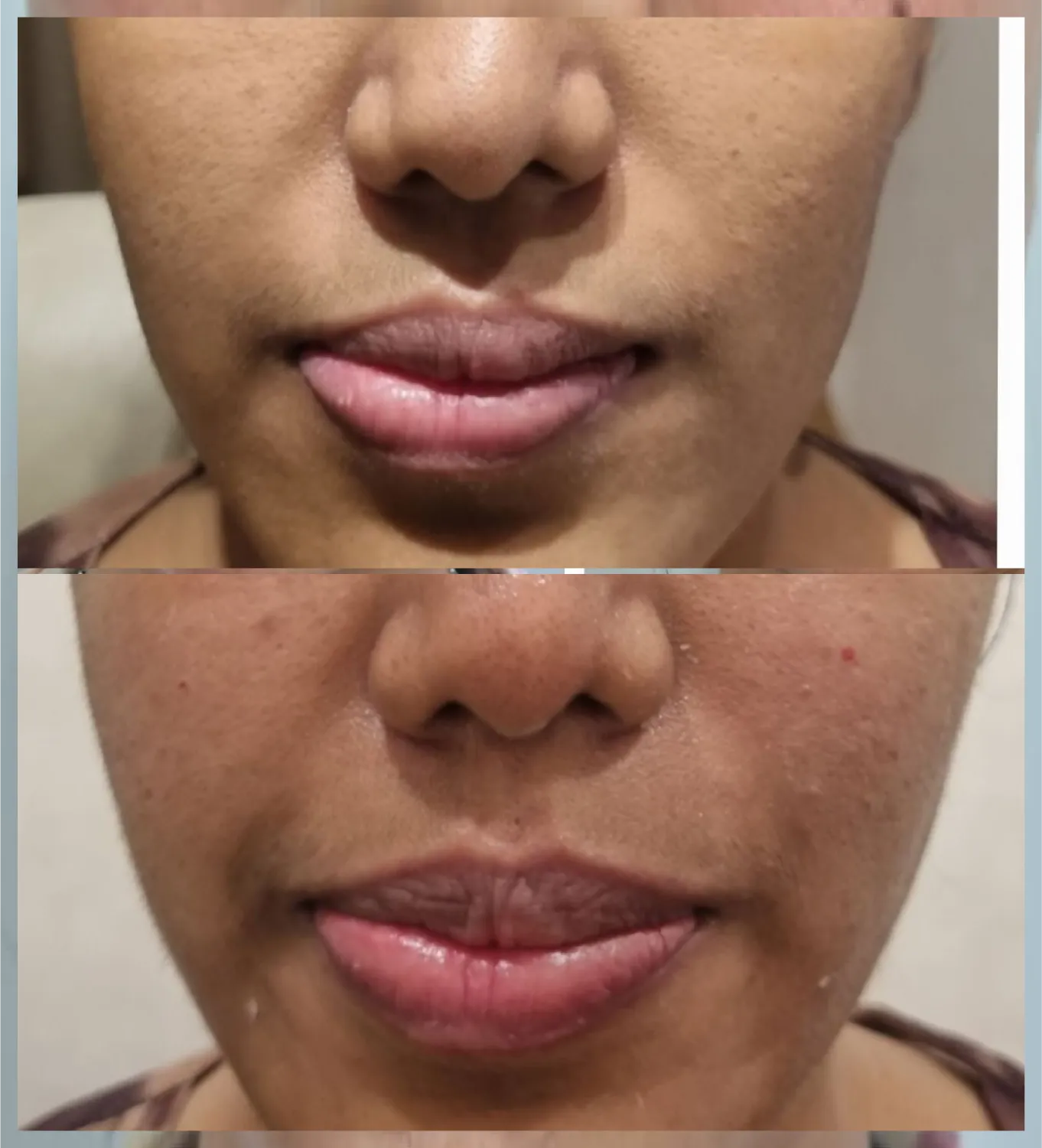 Mid Face Filler
