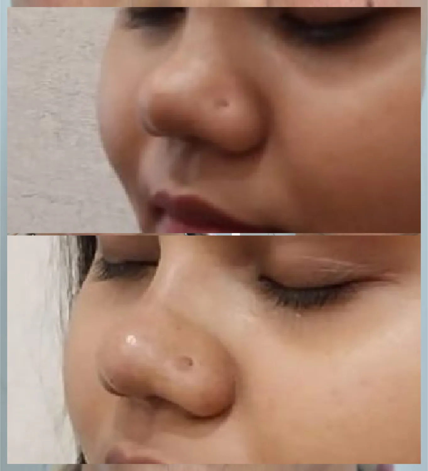 Nose Filler